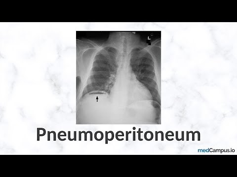 Pneumoperitoneum Chest X-Ray Signs | High Yield | Radiology