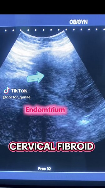Understanding Cervical Fibroids: Symptoms and Treatment