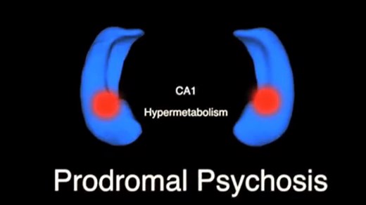 High Levels of Glutamate in Brain May Kick-Start Schizophrenia