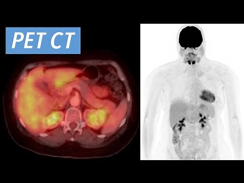 How to Read an F-18 FDG PET CT: An Introductory Approach & Basic Search Pattern