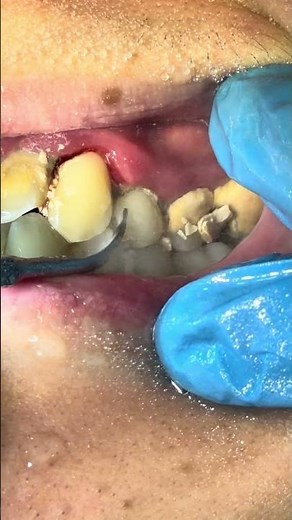 Deep Tartar Removal | Dental Cleaning Detail