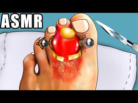 ASMR Satisfying Toe Piercing Treatment | Removing Pus from Piercing | Squeeze Toe Giant Acne