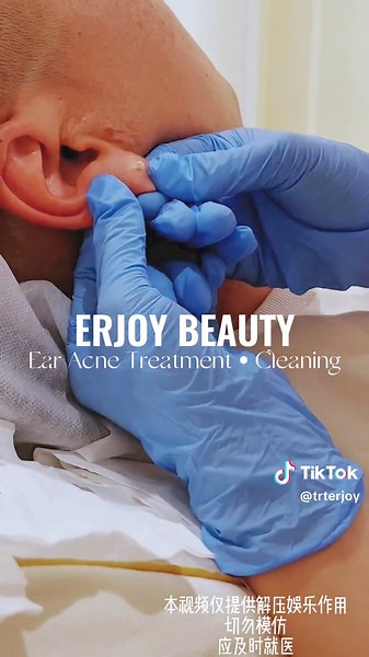Ear Acne Treatment •Cleaning Fix your ears problem #toronto #torontolife #torontotiktok #cleaning #acnefighter #acnetreatments #acnescars #acneproneskin #acnepatch #ear #earwax #earwaxremoval