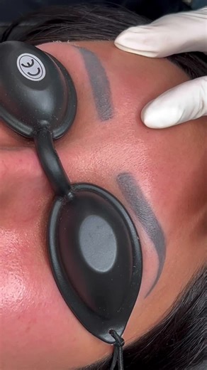 Effective Laser Tattoo Removal for Eyebrows