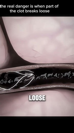 Deep Vein Thrombosis (DVT) #deepveinthrombosis #DVT #bloodclot #medicalanimation