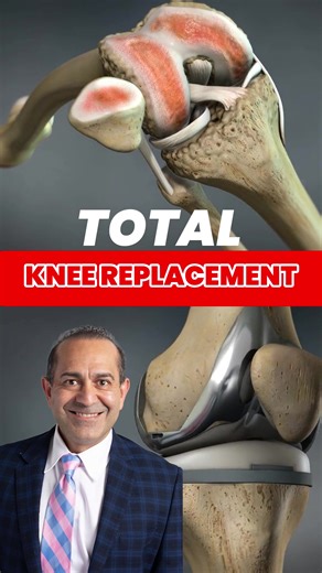 How do we fix a "bone-on-bone" knee for good? We don’t just "replace" your knee—we give it a high-tech upgrade! We trim away the damaged ends of the femur and tibia to make room for smooth metal caps. A medical-grade plastic spacer goes in the middle to act as your new cushion. We even resurface the back of the kneecap so everything glides perfectly. The goal? Walking without pain! 🏃‍♂️ Follow for more surgical breakdowns. #KneeSurgery #JointHealth #Orthopedics #HealthHacks #RecoveryJourney | E