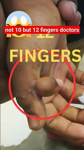 👉 “Child Born with 12 Fingers | Rare Medical Condition Explained”#Shorts #MedicalNews #WeirdFacts in