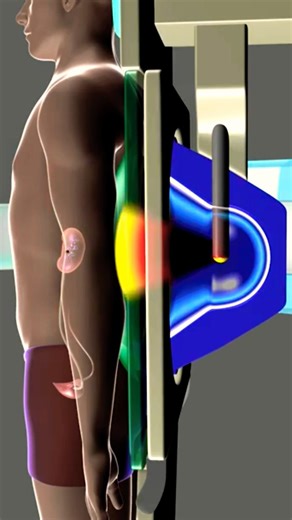 This Tube Can Save Your Kidney 😱⚡ #shorts
