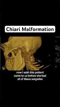 Chiari malformation with decompression surgery and fusion #chiarimalformation