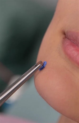 Doctor Eliminates Skin Blemish with ICE Tool #fblifestyle | FoodGasmic