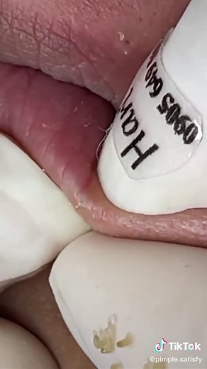 blackheads removal from the lips 💋, #blackheads #satisfying #foryou #pimple #fyp #acne #blackhead