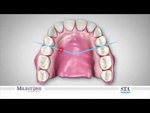 The Wand® STA Instrument - AMSA (Anterior Middle Superior Alveolar nerve block)