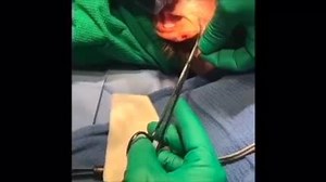 Ear lobe Reduction Surgery (GRAPHIC)