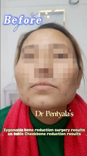 Cheek Bone Reduction Surgery amazing results #zygomaplasty #Face slimming #india # Malarplasty