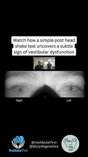 Vestibular First on Instagram: "Seeing right-beating nystagmus after head shake? Here’s what it tells us! The head shake test is a valuable bedside screening tool to detect subtle vestibular asymmetries that may not be apparent during a basic oculomotor exam. In a normally functioning vestibular system, symmetric input from both sides cancels out any nystagmus. However, when one vestibular system is not working as well as the other, the asymmetry in neural firing leads to a temporary imbalance,