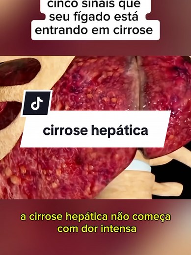5 Sinais de Cirrose Hepática que Você Não Pode Ignorar