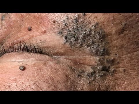 Deep Cleansing Techniques For Oily Skin — Blackhead And Whitehead Removal