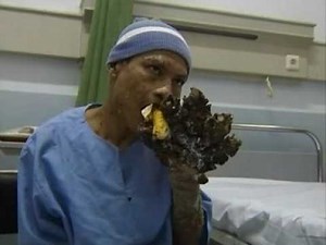 Human Treeman stops turning into a tree