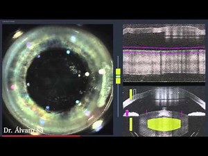 Cirurgia de Catarata com Laser Femtosegundo (FLACS) - Dr. Álvaro Sá