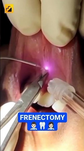 The procedure is called "Frenectomy" (Here using laser) #dentist #frenectomy #dentalstudent