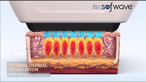 Sofwave™ gives you an in-depth look into our award-winning technology 🙌 Sofwave™ is a highly effective FDA-cleared treatment, clinically proven to stimulate the production of collagen, elastin, and hyaluronic acid at the right depth without disturbing the skin's surface. It goes with minimal downtime and helps to LIFT the skin while addressing fine lines & wrinkles on the face and neck. The procedure is non-invasive, quick, and fits all skin types.💙 SUPERB™ results are consistent with Sofwave™