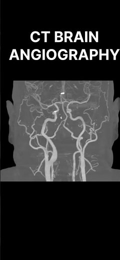 Ct Brain Angiography Explained: Benefits and Procedures