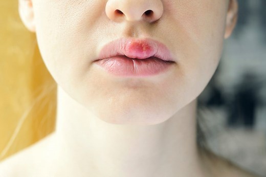 Bouton de fièvre sorti : comment le soigner rapidement ?
