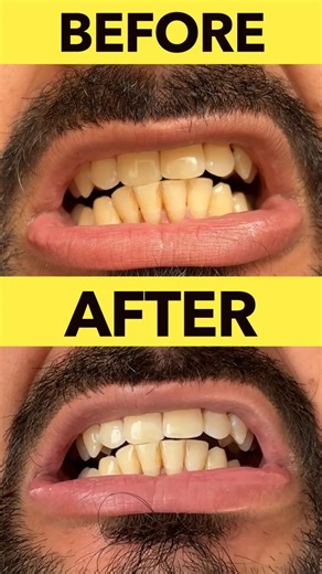 I Tried the Cheapest Teeth Whitening Method