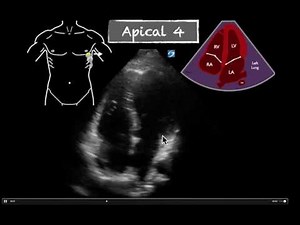 POCUS Cardiac AP4 Normal EF