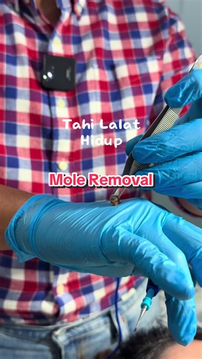 Tahi lalat timbul risiko kanser ✅ tambahan kalau dia ada bulu 🥹 Selepas buang dia akan tinggal kan parut jahitan , boleh pakai ubat parut selepas 2-3 minggu ya ✨🌈 #DrWalid #poliklinikwalid #mole #moleremoval #tahilalat