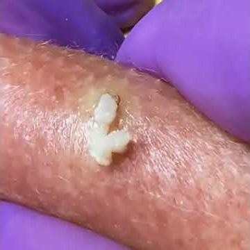 Pickel Ausdrücken Spa - Pickel entfernen & Poren ausdrücken