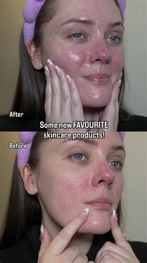 Top TXA Serum for Radiant Skin