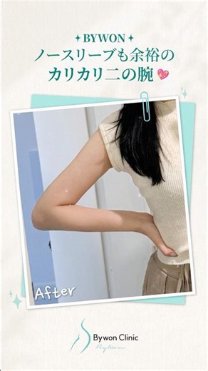 夏を制覇する真っすぐ華奢な腕＆直角肩を二の腕脂肪吸引で叶える♡#shorts #韓国整形 #脂肪吸引