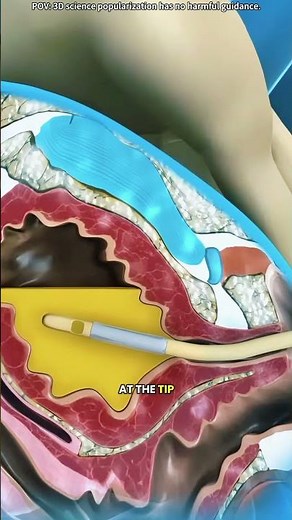 Foley catheter procedure (3D animation)