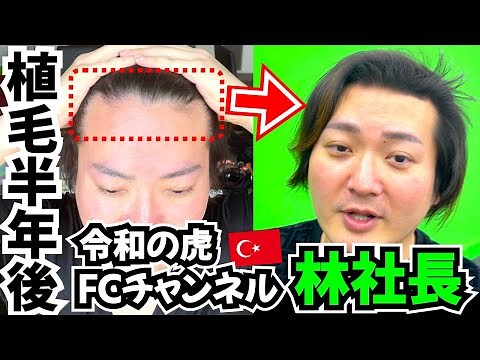 【髪の毛】令和の虎 林社長のトルコ植毛から半年経過【自毛植毛｜フランチャイズチャンネル】