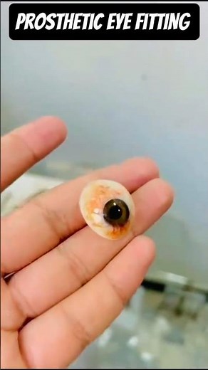 Real Case of Artificial Eye Placement| Before & After|Prosthetic Eye#artificialeye