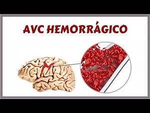 Hemorrhagic Stroke - HSC