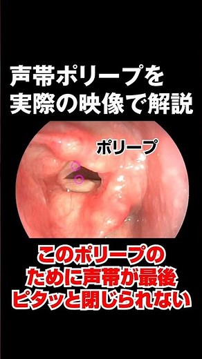 声帯ポリープの様子を映像で解説【耳鼻科医が解説】