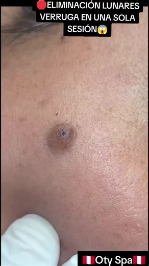 🛑ELIMINACIÓN Y CAUTERIZACIÓN DE LUNARES, VERRUGAS,ACROCORDONES EN EL CUELLO,EN UNA SOLA SESION Y PARA SIEMPRE 100% EFECTIVO CON GARANTIA⁉️ #fyp #parati #lima #eliminaciondelunares #viral