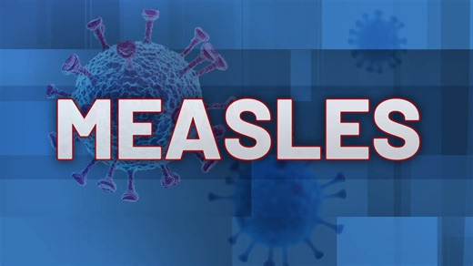 Potential measles exposure linked to eastern Iowa hotel