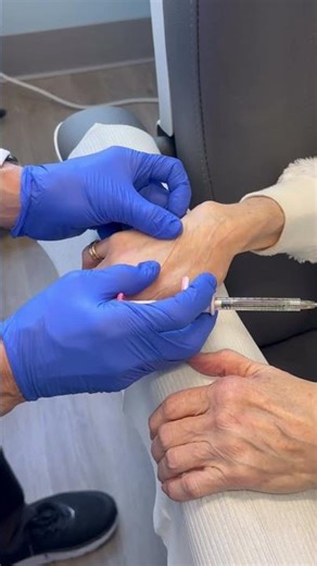 Dermal Filler for Hand Rejuvenation #medicalaesthetics #handrejuvenation #juvederm