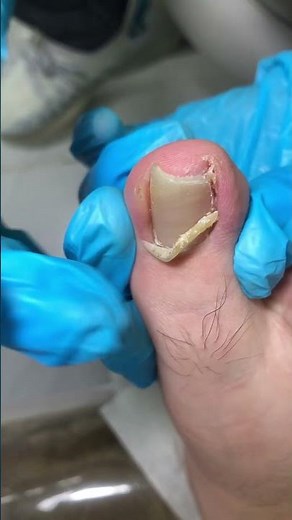 Amazing Toenail Trimming... #pedicure #toenails