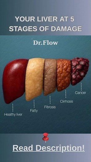 Stages of Liver Damage Explained (Healthy → Fatty → Fibrosis → Cirrhosis → Cancer)