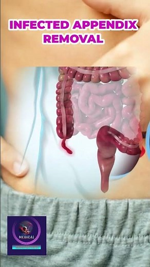 Infected Appendix Surgery Procedure
