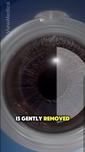 How Corneal Cross Linking Surgery Is Performed | Eye Surgery #cornealcrosslinking #eyesurgery