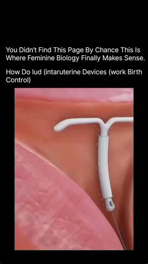 Periods | Hormones | Fertility on Instagram: "An IUD (Intrauterine Device) is a tiny T-shaped medical device placed inside the uterus to prevent pregnancy — and it works 24/7 without you doing anything! There are two powerful types of IUDs: 🔹 Copper IUD The copper releases ions that kill sperm instantly, making the uterus a no-entry zone for fertilization. It also changes the uterine environment so implantation becomes impossible. 🔹 Hormonal IUD This releases a small amount of ho