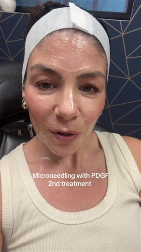 Microneedling with PDGF: My 2nd Treatment Experience