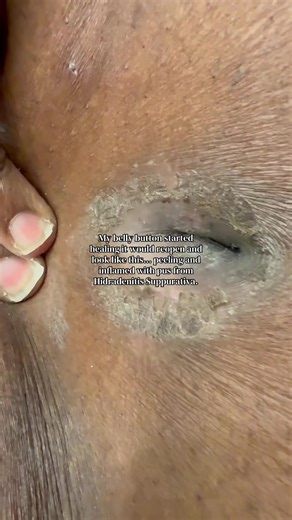 My belly button started healing… and then it reopened and looked like this. Peeling skin. Inflammation. Drainage. Pus. Pain that doesn’t always show on the outside but lives in every movement I make. This is what Hidradenitis Suppurativa looks like for me — a constant cycle of healing, reopening, hoping, and managing. Just when you think your body is giving you a break, it reminds you that chronic illness doesn’t move on your timeline. This part is exhausting. It affects how I dress, how I move,