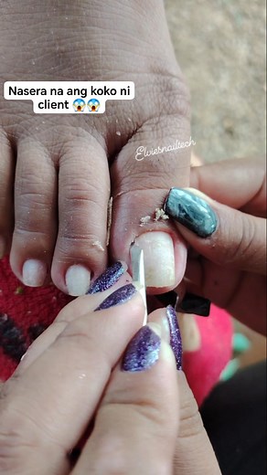 Naserang koko ni client kunin natin😱😱 #pedicure #nailcare #nailcleaning #nails #nailsofinstagram #nailtech #nailtechnician #nailtechlife #nailtransformation #IngrownToenail #ingrowntoenailremoval #ingrownnail #dryskin #dryskinremoval #dryskincare #Manicure #manicurepedicure #manicurista #nailsnailsnails #nailsoftheday #viralnails #virals #tutorial #satisfying #satisfyingvideos #satisfiedcustomer #SatisfiedClients #highlightseveryone #reelsvideoシ #reelsfbシ #NailTrends2025 #reelsfypシ #satisfied 
