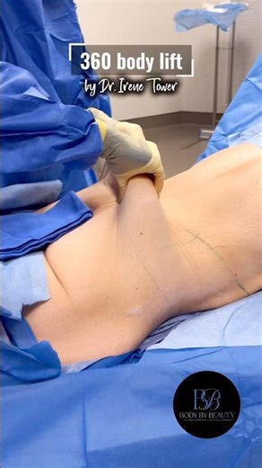360 Body Lift after Bariatric Surgery!